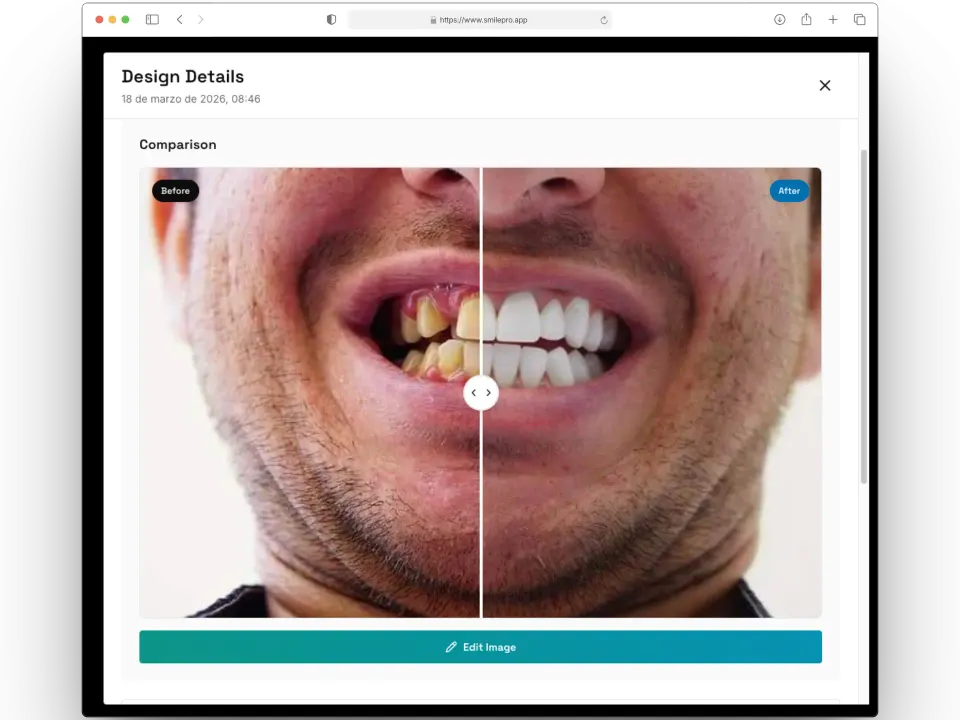 Detalle de un diseño en SmilePro: comparación antes y después de una simulación de sonrisa con IA